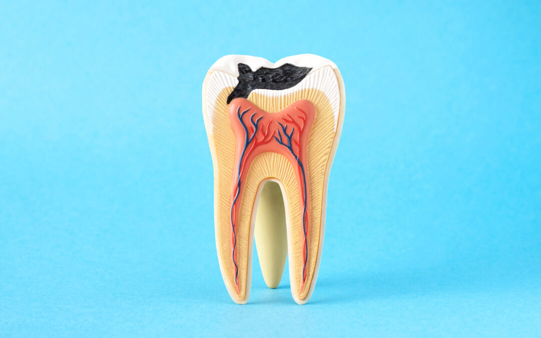 Lawsuits Arising from Dental Damage Caused by Suboxone Consolidated into MDL